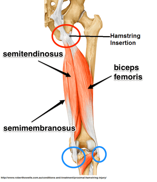 Hamstring Insertion PRP Helpful – newpainmuse