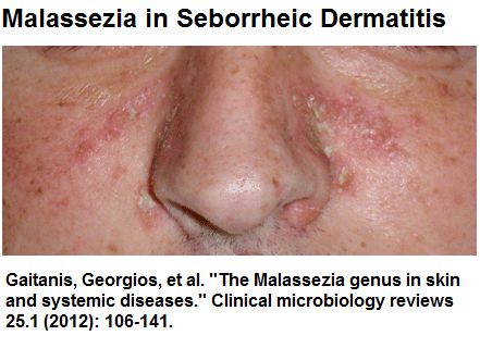 malassezia