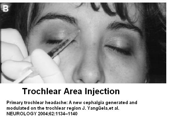 trochlear inject1